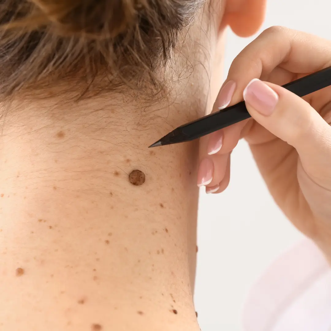 Mole, Wart & Skin Tag Removal.webp